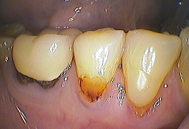 abrasion-cavities