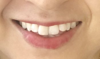 Bleaching teeth