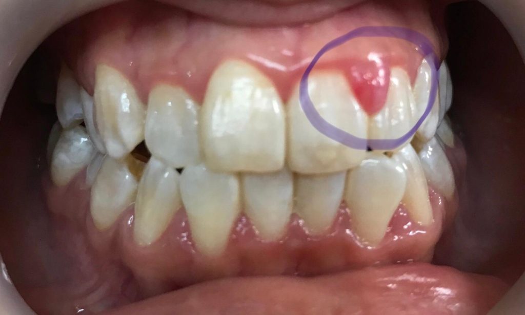 Gum swelling