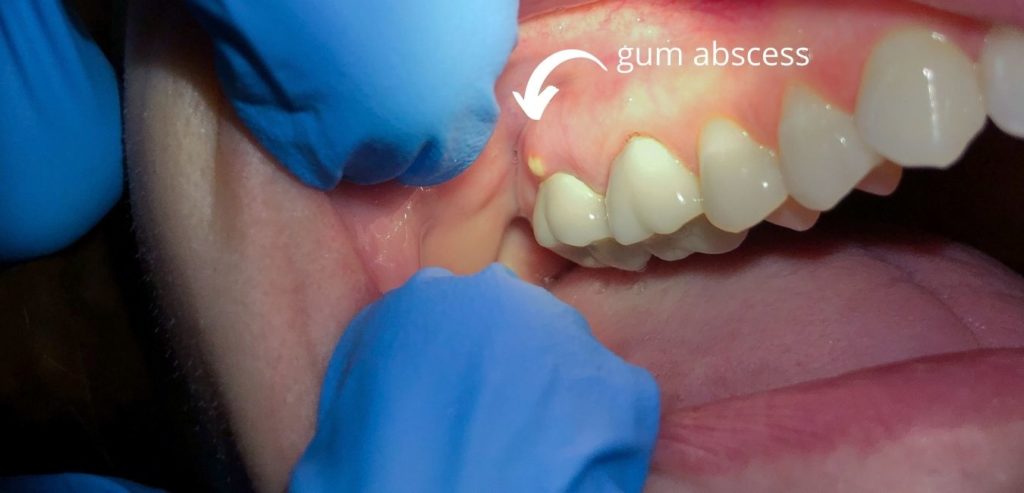 Why is there a bump in my gums?