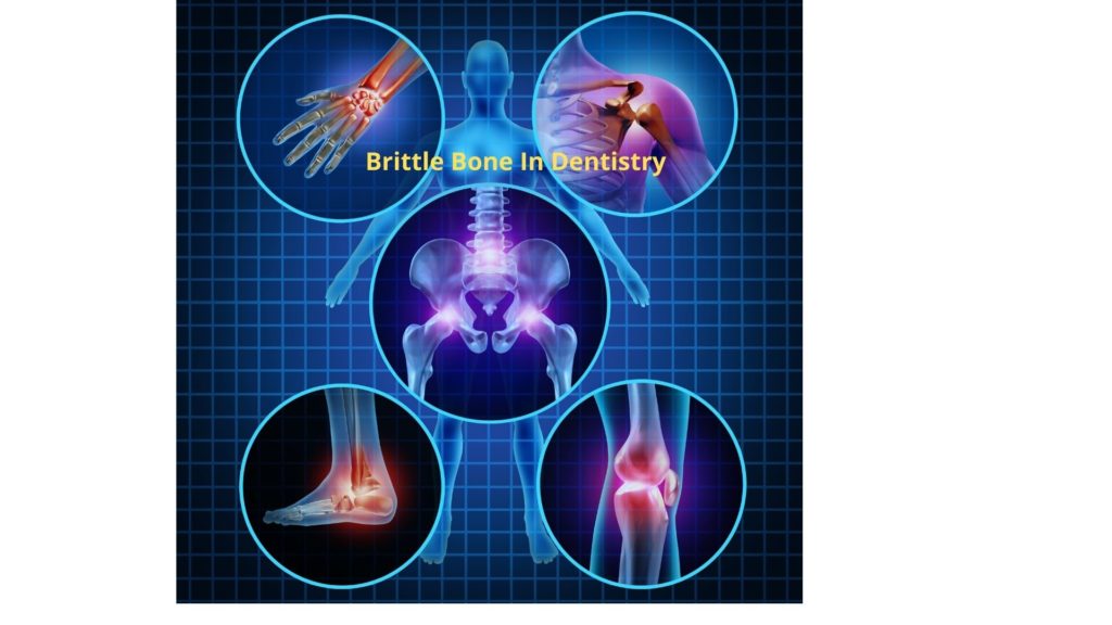 Brittle bone and dental health